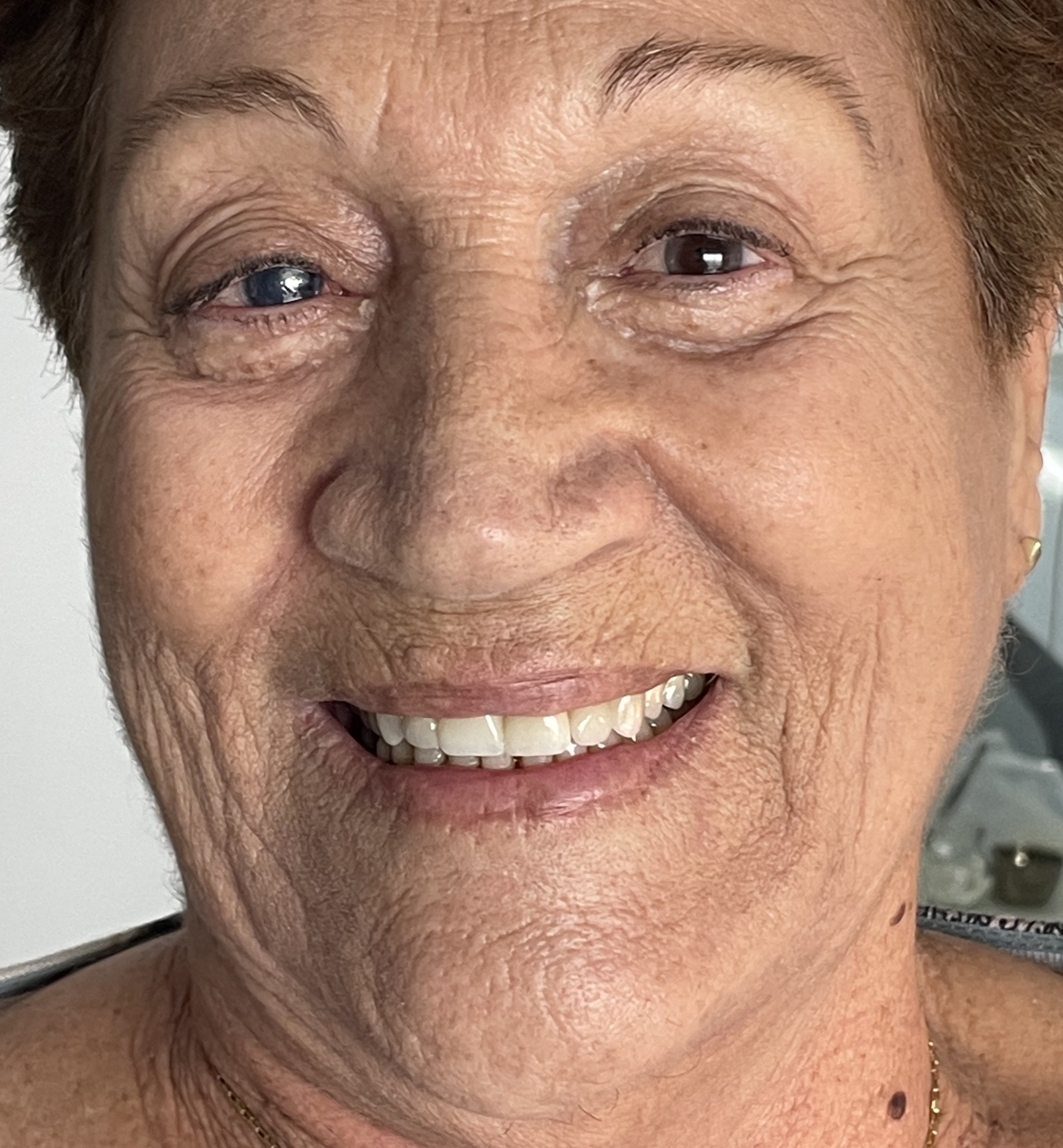 Paciente 4 - Después