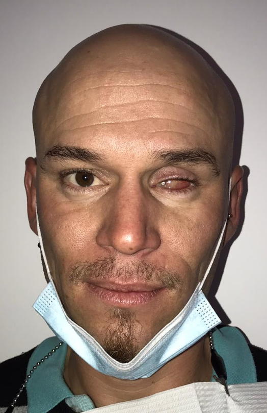 Paciente - Antes de prótesis ocular