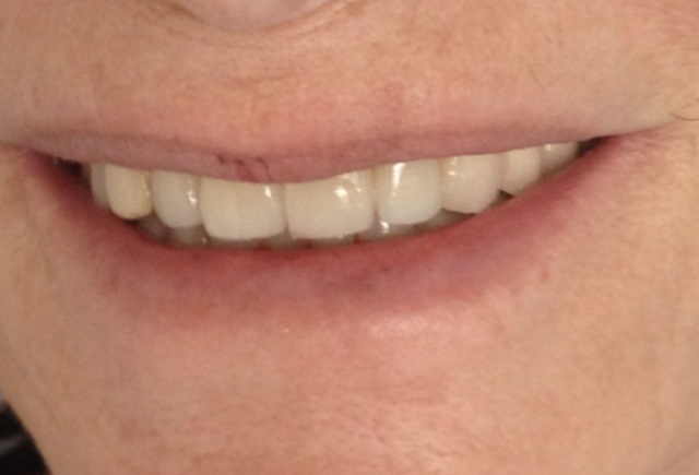 Paciente 8 - Después