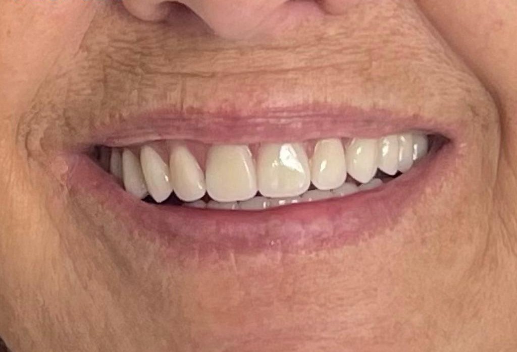 Paciente 3 - Después