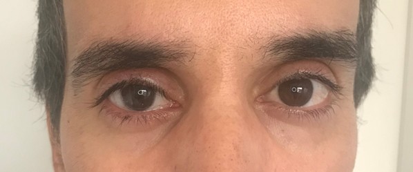 Paciente 3 - Con prótesis ocular