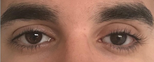 Paciente 1 - Con prótesis ocular