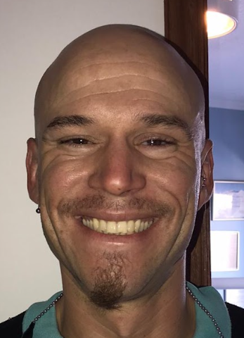 Paciente - Después de prótesis ocular