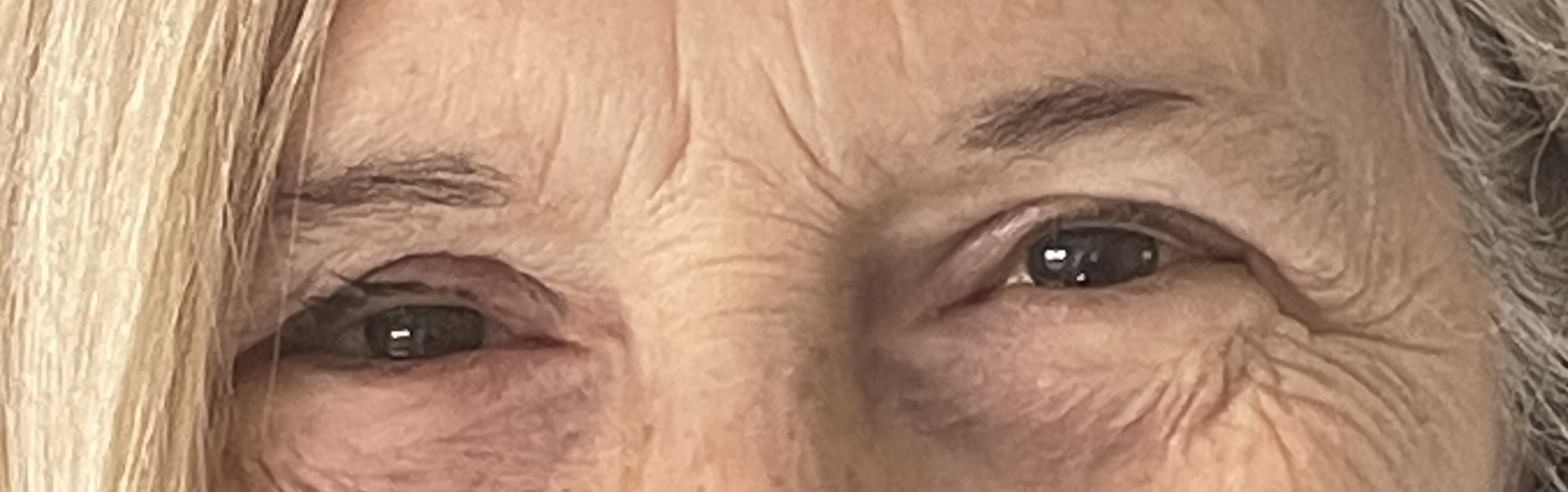 Paciente 5 - Con prótesis ocular