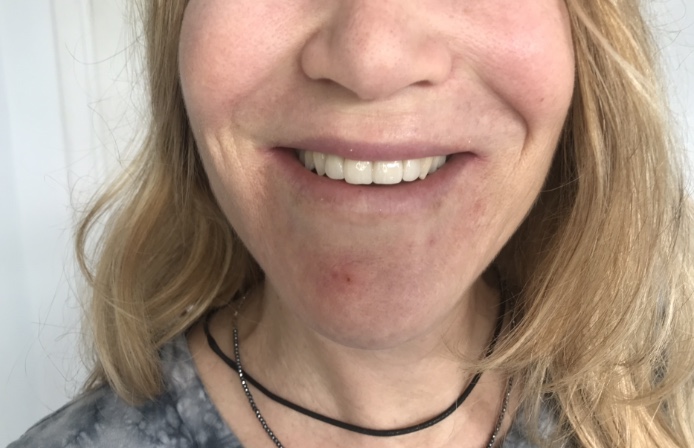 Paciente B - Después del tratamiento