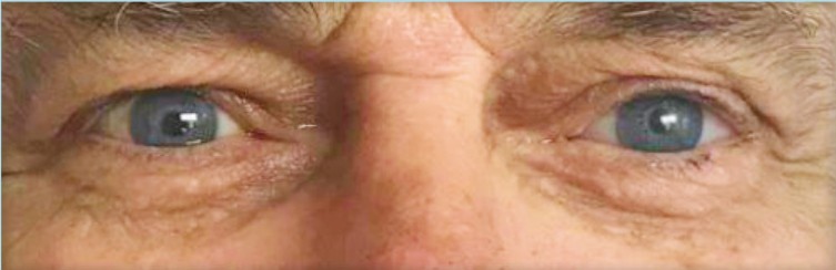 Prótesis ocular - Resultado final