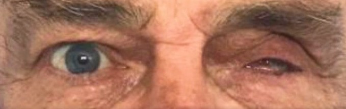 Prótesis ocular - Estado inicial