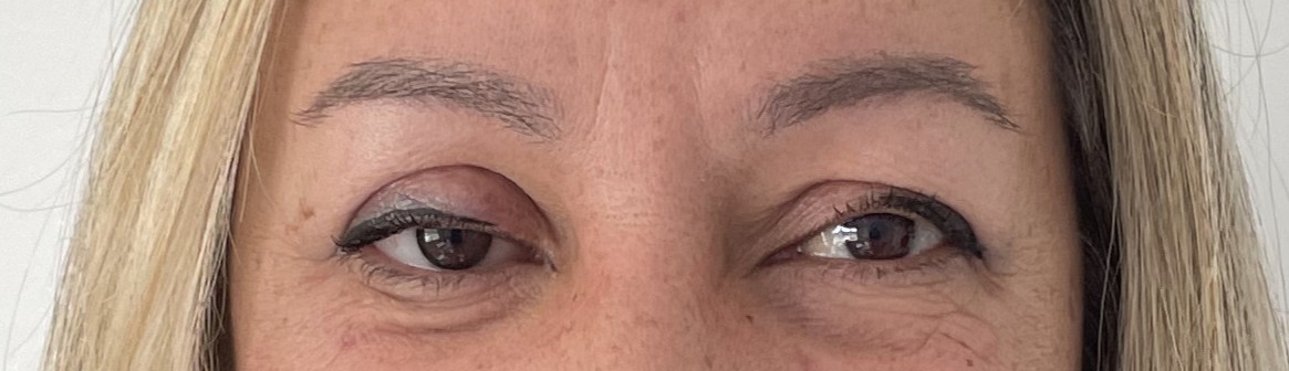 Paciente 2 - Con prótesis ocular