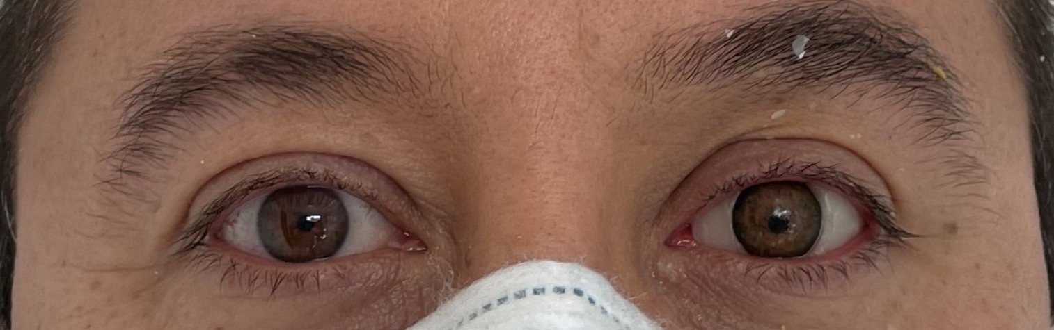 Paciente 7 - Con prótesis ocular