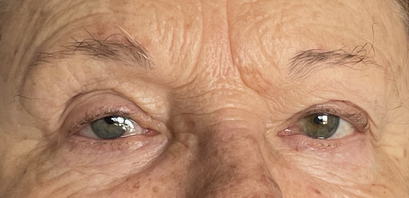 Paciente 6 - Con prótesis ocular