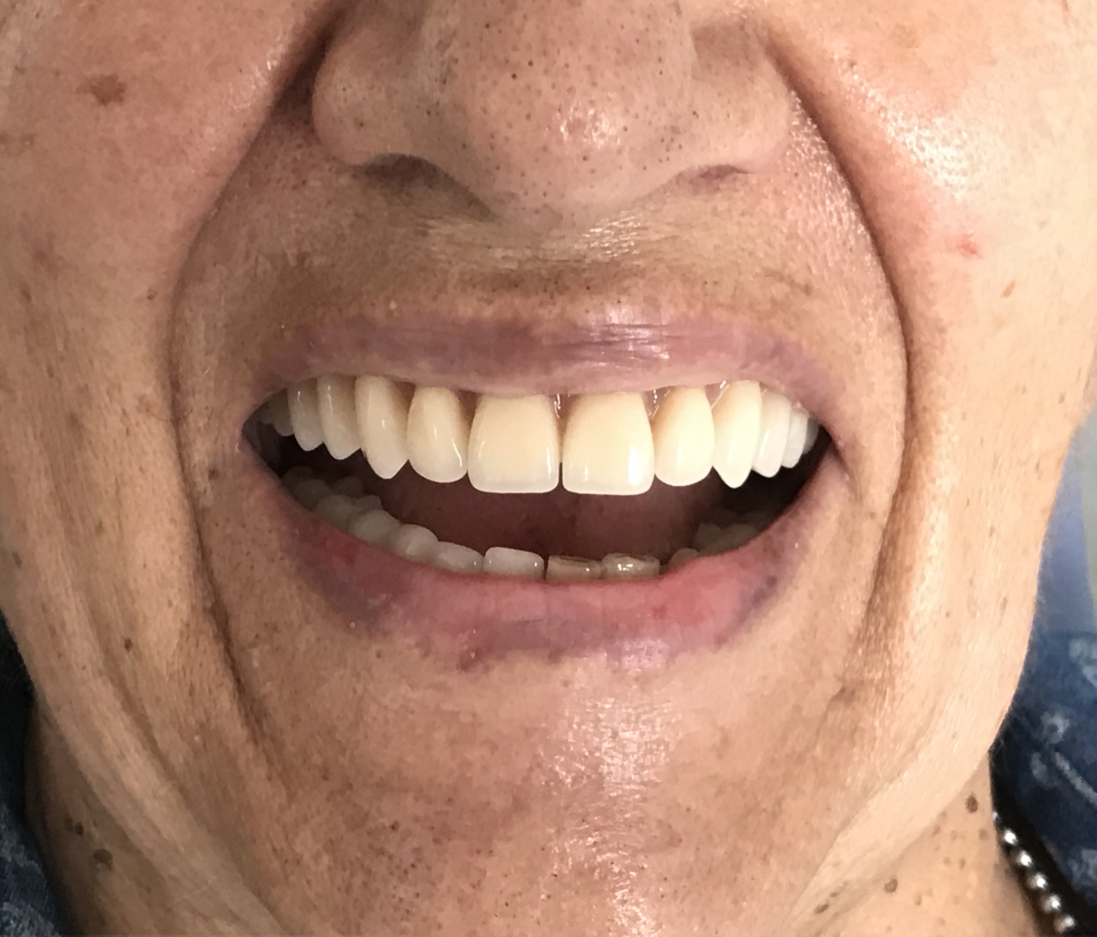 Paciente 1 - Después